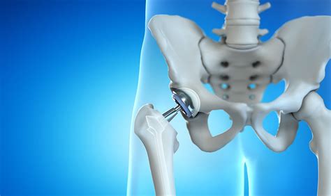 anterior hip replacement near me.